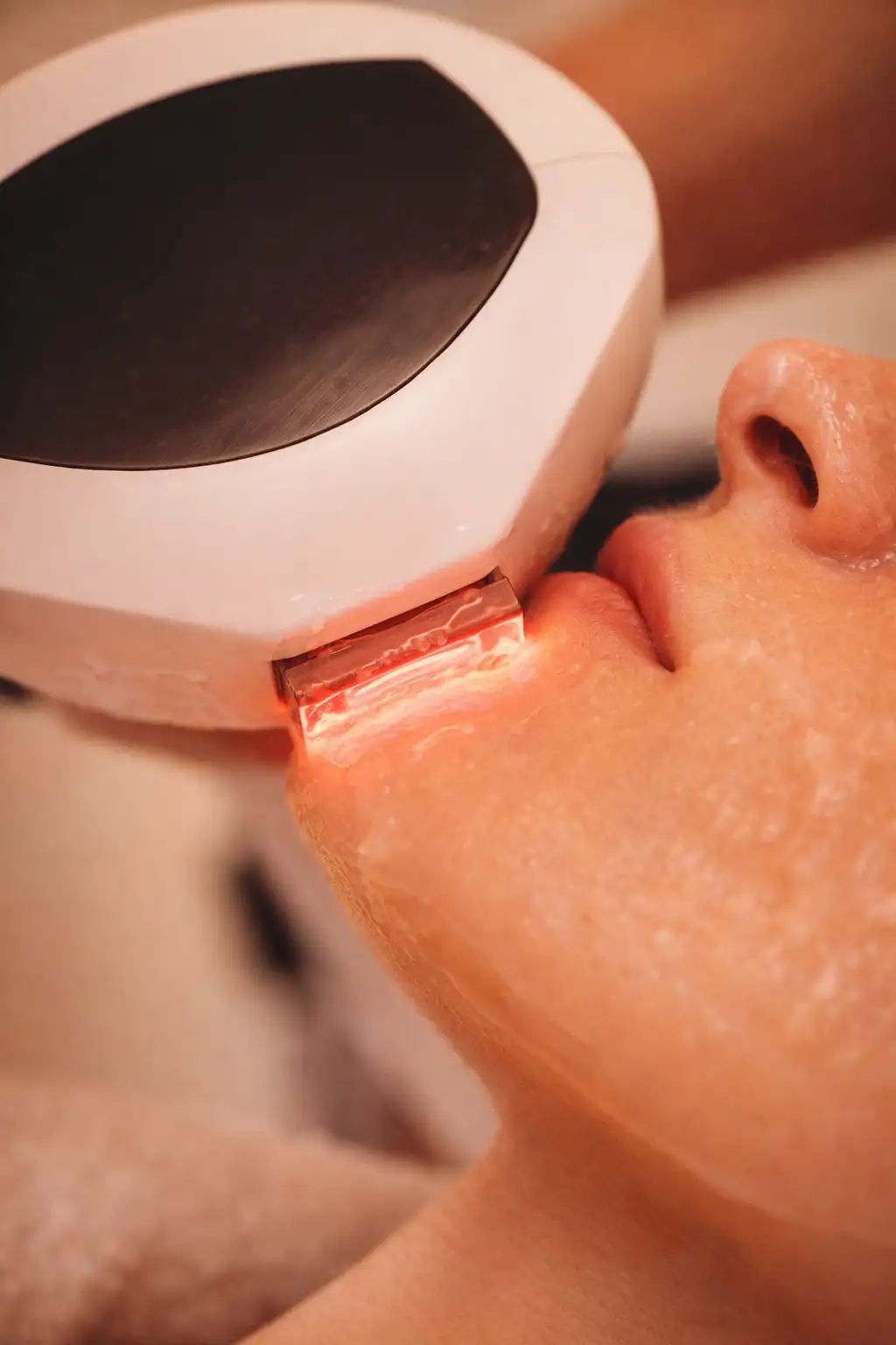 IPL Treatment treatment procedure - before and after results